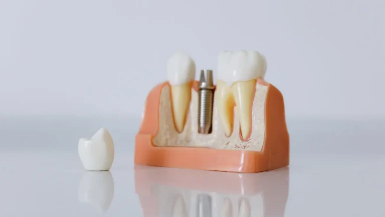 Close-up of a dental implant model featuring artificial teeth and jaw structure.